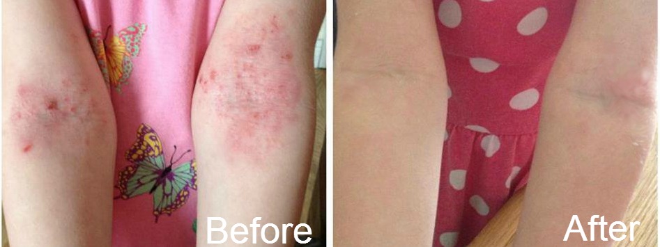 Flexural excema young girl